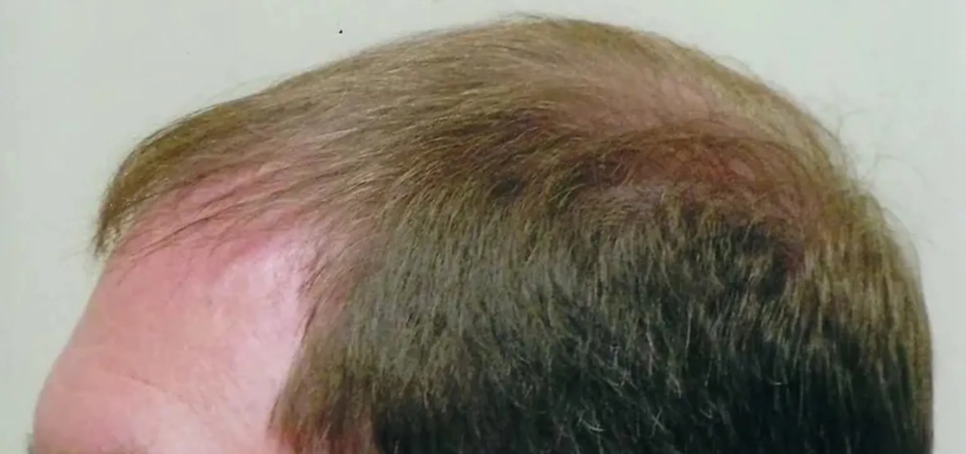 After treatment 2
