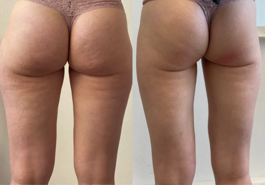 T-Shape 2 Body Contouring